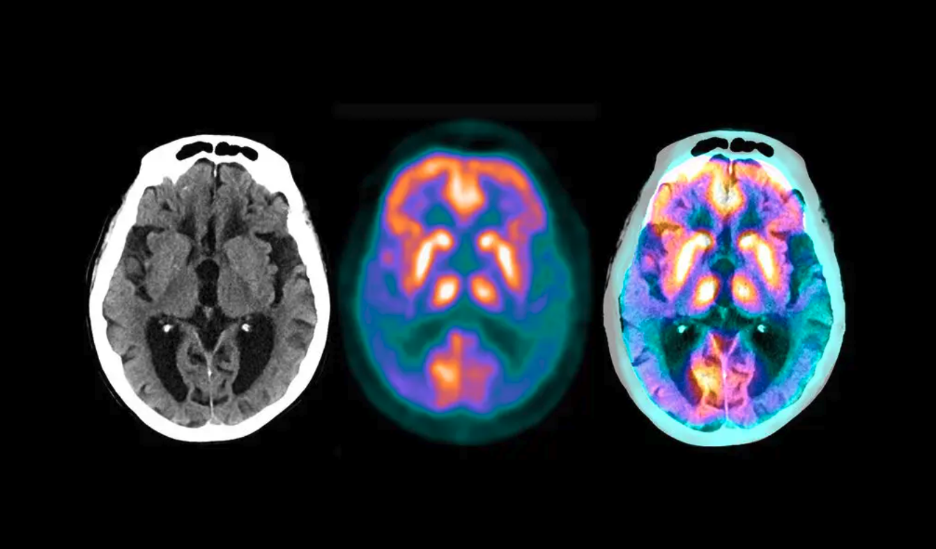 Brain scans of alzheimers patients| Disruptive innovation
